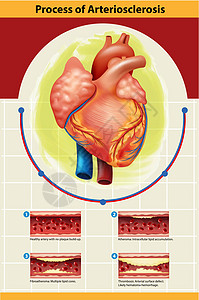 动脉硬化过程海报艺术器官静脉科学图表医疗疾病绘画插图生物图片