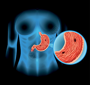 人体胃溃疡图x光疾病生物学图表教育艺术绘画生物夹子癌症图片