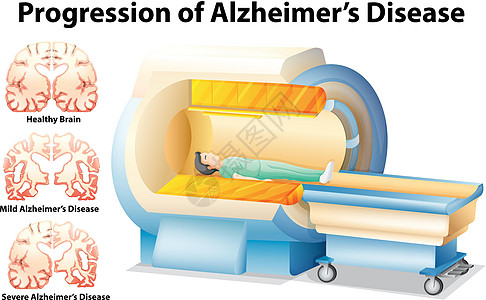 阿尔茨海默病的进展图表男人机器x光扫描器官夹子治疗生物学科学图片