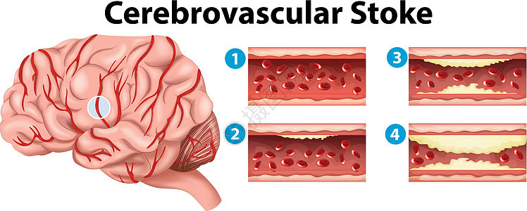 显示脑血管中风阶段的图表图片