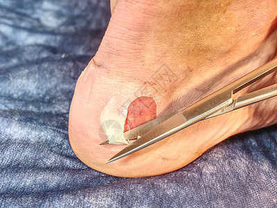 护士帮助忍受脚跟皮肤擦伤的病人治疗病变护发素消毒糖尿病男生危险粉刺水疱身体图片