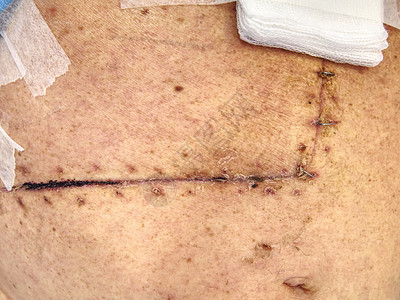 胆囊和肠胃手术后腹部有伤疤的病人图片