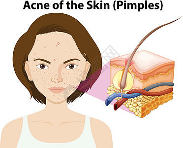 woma 上的皮肤痤疮图片