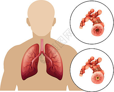 人类慢性阻塞性肺病图片