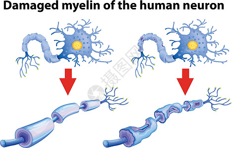 人类神经的受损髓鞘图片