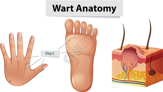 手上的人体解剖学疣和 Foo图片