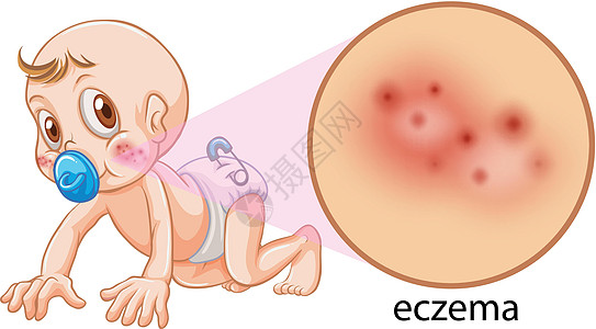患有湿疹的婴儿的载体图片