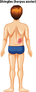 背带状疱疹的男人图片