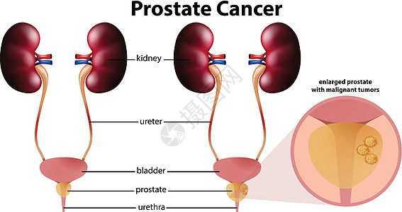 在白色背景上的前列腺癌解剖学教育医疗膀胱绘画艺术插图夹子身体男人图片