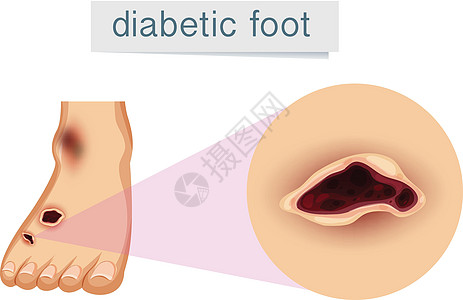 患有糖尿病的人脚医疗解剖学治疗夹子药品艺术绘画疾病胰岛素损害图片