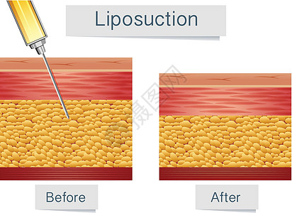 吸脂医学治疗与比较图片
