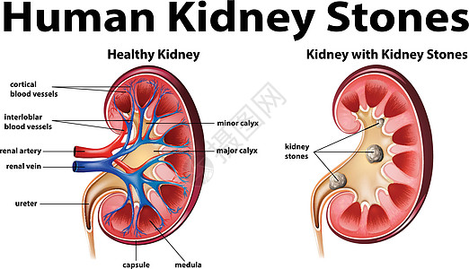 肾结石人体解剖图图片