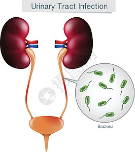 白底尿路感染疾病生物学身体小便池图表女性尿道夹子细菌尿液图片