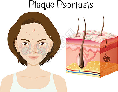 银屑病斑块的人体解剖学卵泡疾病缺陷真皮夹子卫生头发皮肤状况感染图片