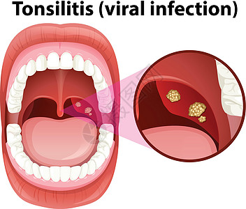 人类口腔扁桃体炎感染图片