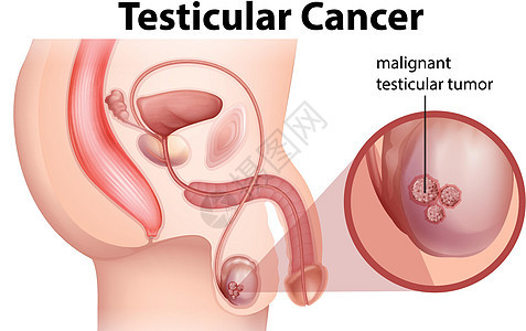 睾丸癌的男性解剖学图片