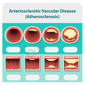 显示动脉硬化性血管疾病的图表图片