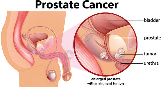 前列腺癌示意图图片
