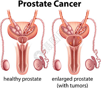 健康和癌症前列腺的比较图片