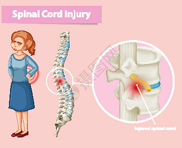 显示人类脊髓损伤的图表图片