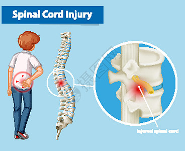 显示脊髓损伤的图表药品解剖学男人绘画夹子生理女性男性脊柱骨骼图片