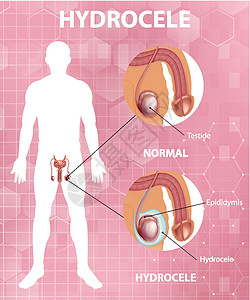 显示男性正常睾丸和鞘膜积液之间差异的医学海报状况艺术疼痛夹子医疗插图绘画学习药品男人图片