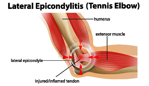 外侧上髁炎或网球肘框架闲暇神经生活弱点药品肱骨指示牌病人疗法图片