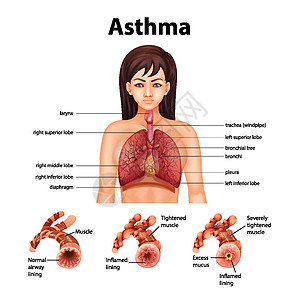 健康肺与哮喘肺的比较插图哮喘病器官生物学解剖学疾病病理科学学习图表图片