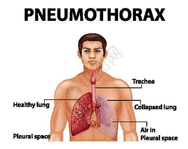 气胸的资料图插图信息剪贴x光科学图表学习意义解剖学药品图片