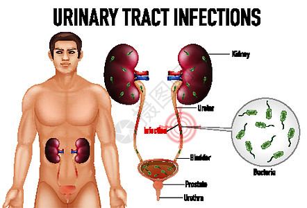 尿路感染的资料图刀片男人疾病病理身体图表海报绘画教育科学图片