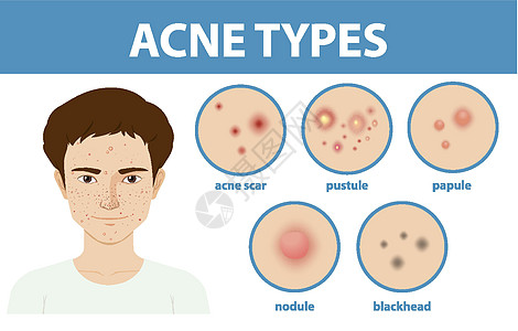 皮肤上的粉刺或粉刺类型框架黑头插图毛孔护理卡通片空白指示牌瘢痕疾病图片