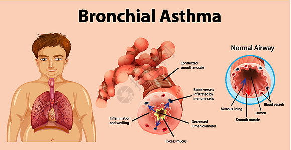 哮喘发炎的支气管管生理哮喘病图表科学教育微生物学学习管子男人x光图片