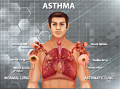 健康肺与哮喘肺的比较教育科学海报器官支气管病理哮喘病图表解剖学学习图片