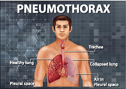 气胸的资料图图表插图科学学习教育艺术医疗信息生物学意义图片