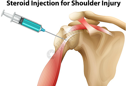肩伤类固醇注射图片