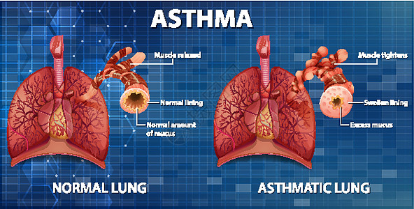 健康肺与哮喘肺的比较药品哮喘病生物学身体疾病学习教育微生物学生理管子图片