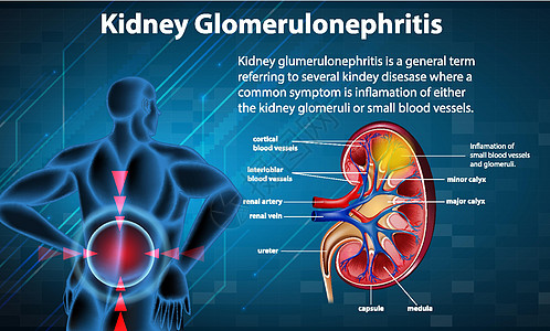 肾小球硬化的医学信息图生物学状况疼痛药品疾病解剖学图表肾脏夹子卡通片图片