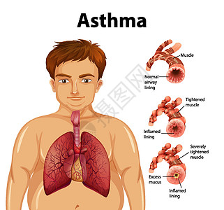 健康肺与哮喘肺的比较插图生物学哮喘病微生物学管子卡通片图表肥胖科学绘画图片