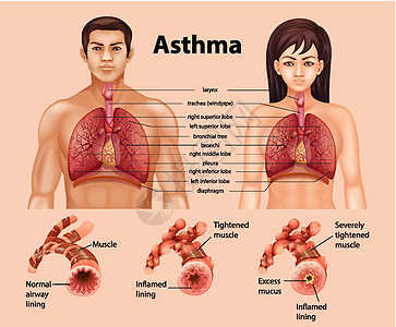 健康肺与哮喘肺的比较生理教育药品x光绘画海报信息图表支气管科学图片