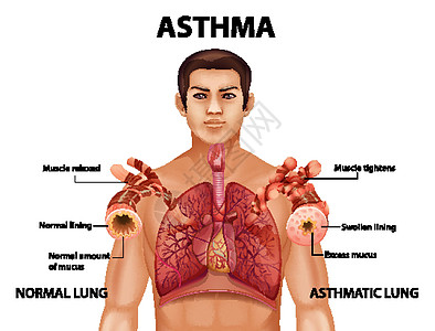 健康肺与哮喘肺的比较器官生物学微生物学科学男性解剖学药品图表病理学习图片