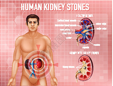肾结石资料图男人科学药品肾脏身体剪贴微生物学意义生物学医疗图片