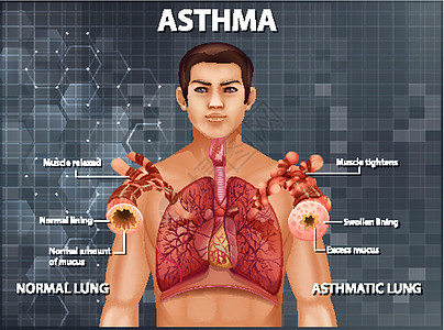 健康肺与哮喘肺的比较生物学病理生理管子器官科学教育微生物学卡通片绘画图片