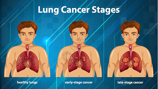 肺癌分期的资料图教育生理学习药品微生物学图表病理绘画解剖学器官图片