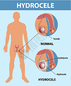 显示男性正常睾丸和鞘膜积液之间差异的医学海报教育状况疼痛学习艺术疾病男人附睾插图卡通片图片