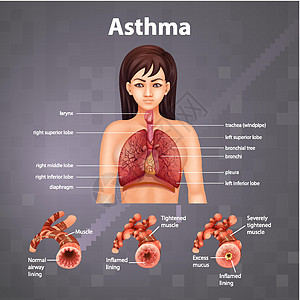健康肺与哮喘肺的比较身体支气管教育信息解剖学管子插图科学生理哮喘病图片