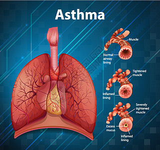 健康肺与哮喘肺的比较生理插图解剖学生物学病理x光哮喘病支气管信息教育图片