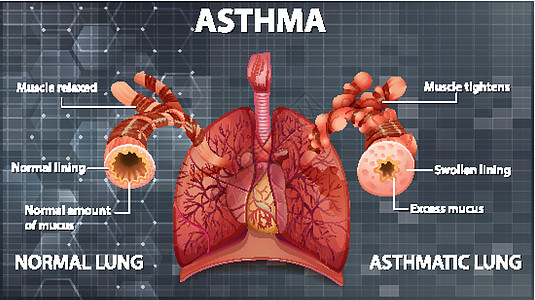 健康肺与哮喘肺的比较支气管插图教育病理器官海报微生物学生物学学习哮喘病图片