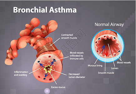 哮喘发炎的支气管管病理身体支气管解剖学教育疾病管子插图x光信息图片