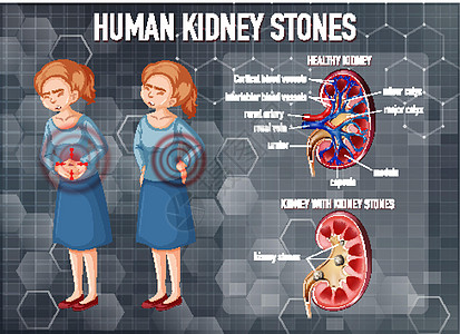 健康肾与结石肾对比科学图表绘画胶囊药品卡通片插图生理器官意义图片