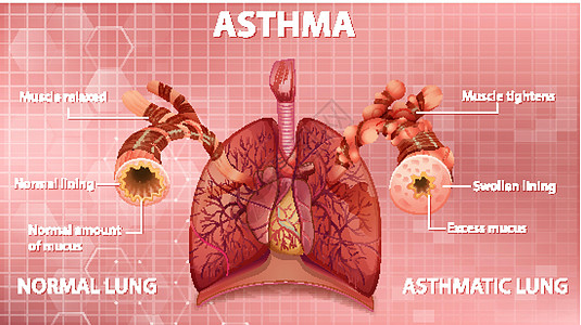 健康肺与哮喘肺的比较病理哮喘病微生物学支气管x光学习插图身体科学管子图片